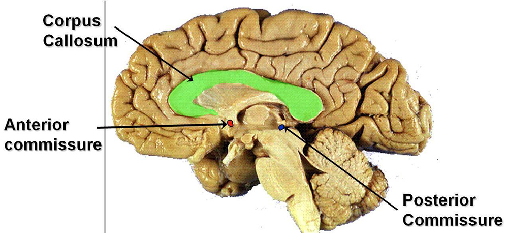 006 CorpusCallosumAnteriorComissure